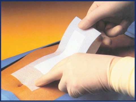 PHARMAPLAST PHARMAPORE 10 × 30 cm Opatrunek samoprzylepny jałowy włókninowy PHARMAPLAST PHARMAPORE 10 × 30 cm Opatrunek samoprzylepny jałowy włókninowy